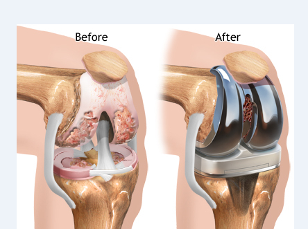 Download best-knee-replacement-surgeon-in-delhi-ncr.png