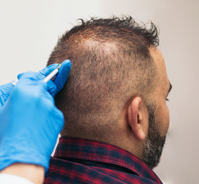 Download Hair Loss Treatment in Delhi – PRP, Transplants & Advanced Therapies Explained