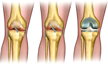 Download What is ACL Surgery in Delhi?