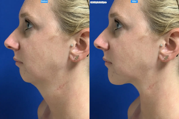 Download Simulate Chin Augmentation and Neck Lift Online with FaceTouchUp