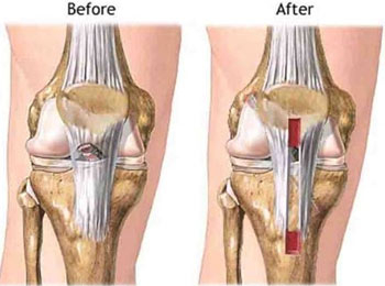 Download  PCL Reconstruction and PCL Surgery in Delhi, India