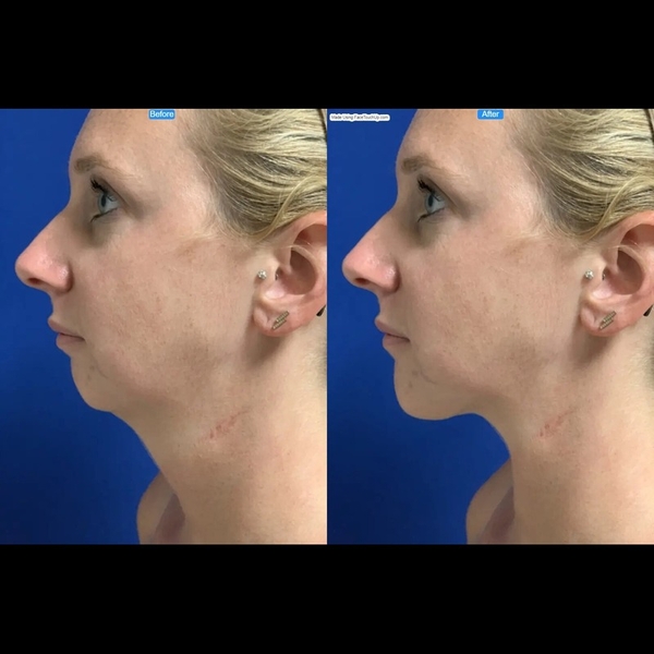 Download Transform Your Profile: Simulate Chin Augmentation and Neck Lift with FaceTouchUp
