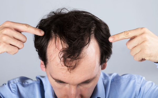 Download Hair Loss Treatment - Comprehensive Hair Restoration Guide