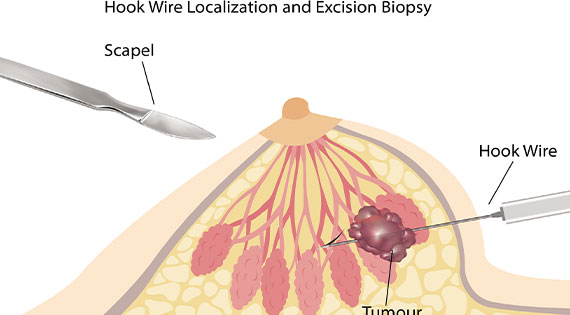 Download Hookwire Localization and Excision of Lumps